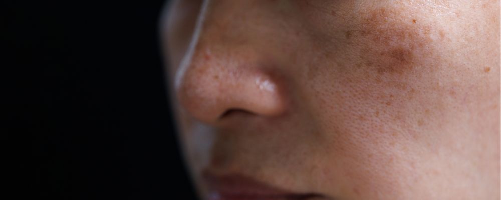 Przebarwienia hormonalne – dlaczego powstają i jak je rozjaśnić?