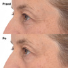 Murad Płatki pod oczy z retinolem Retinol Youth Renewal Eye Masks