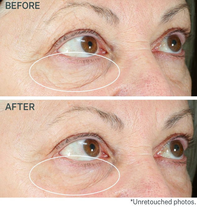 HYPERLIFT™ Natychmiastowa kuracja napinająca i liftingująca pod oczy