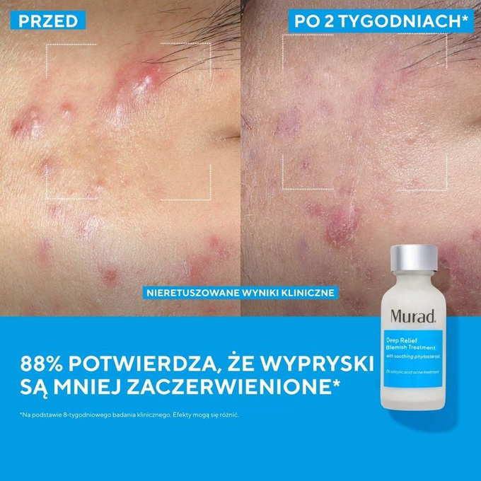 Murad Kuracja na podskórne niedoskonałości Deep Relief Blemish Treatment