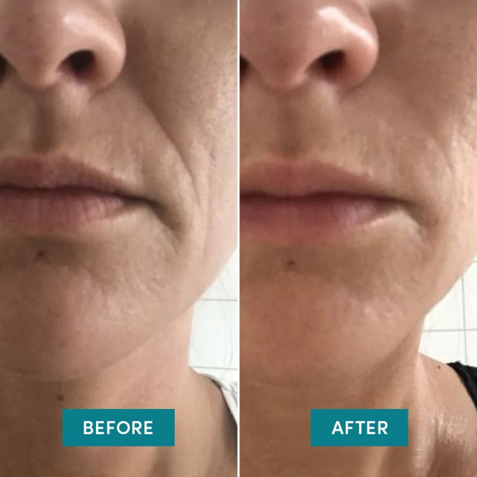 APRICOT przeciwzmarszczkowe plastry na bruzdy nosowo-wargowe „skin whisperer‘‘ 24 szt