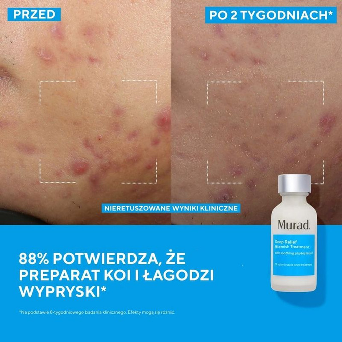 Murad Kuracja na podskórne niedoskonałości Deep Relief Blemish Treatment